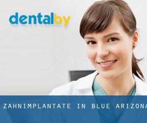 Zahnimplantate in Blue (Arizona)