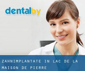 Zahnimplantate in Lac-de-la-Maison-de-Pierre